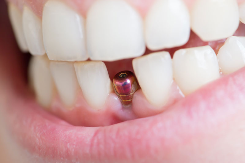 Dental Implant Post In A Dental Patient's Lower Front Jaw