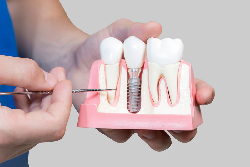 Dental Assistant Showing Off A Dental Implant In A Jawbone Cutaway Model in Saratoga Springs, UT