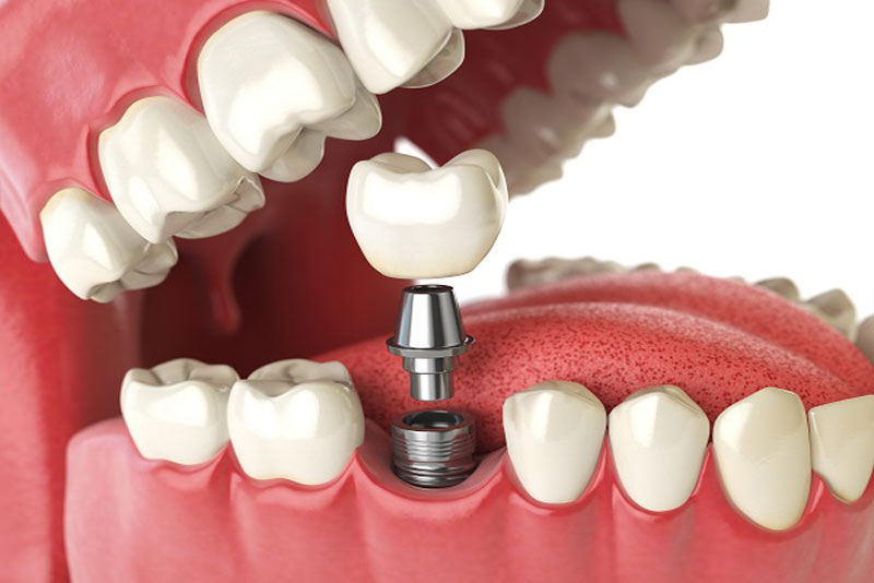 a picture of a single dental implant being implanted in a full mouth model