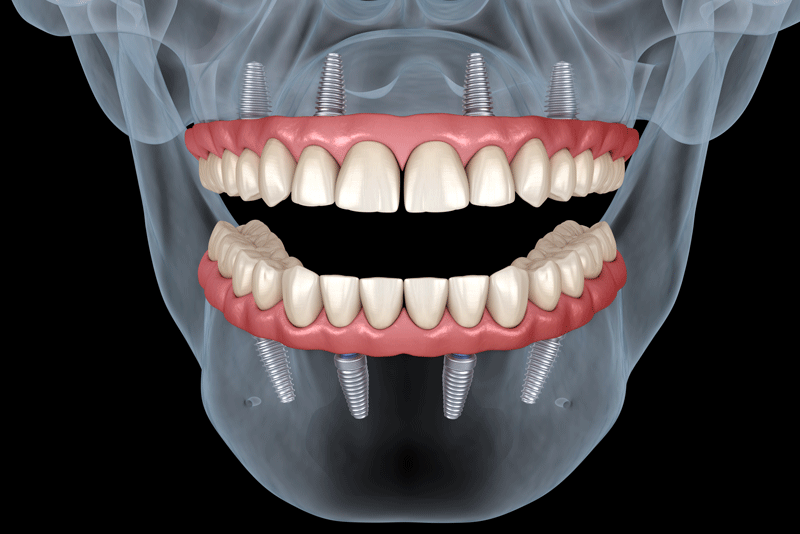 an x-ray image of a patients face after All-On-4 dental implants have been placed in the patients mouth. the All-On-4 dental implants are in color while the x-ray image is in black and white.