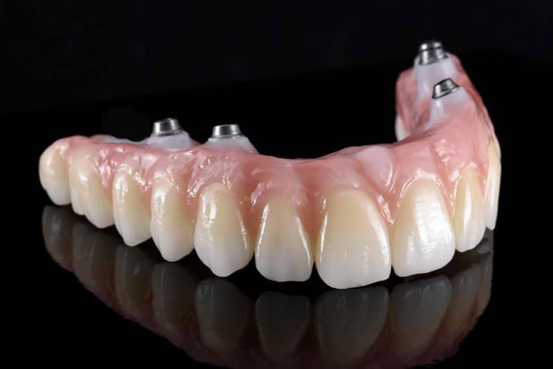 a picture of a zirconia bridge, with dental implants in it, that can be used in a zirconia fixed bridge procedure.