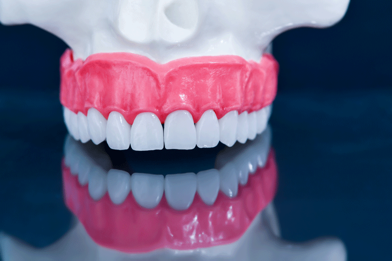 An image of a full mouth dental implants.