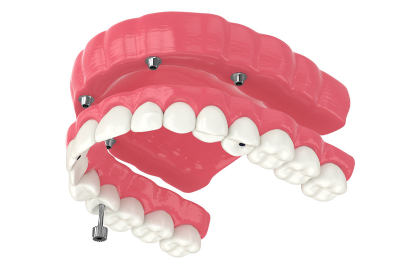 An image of full mouth dental implant model.