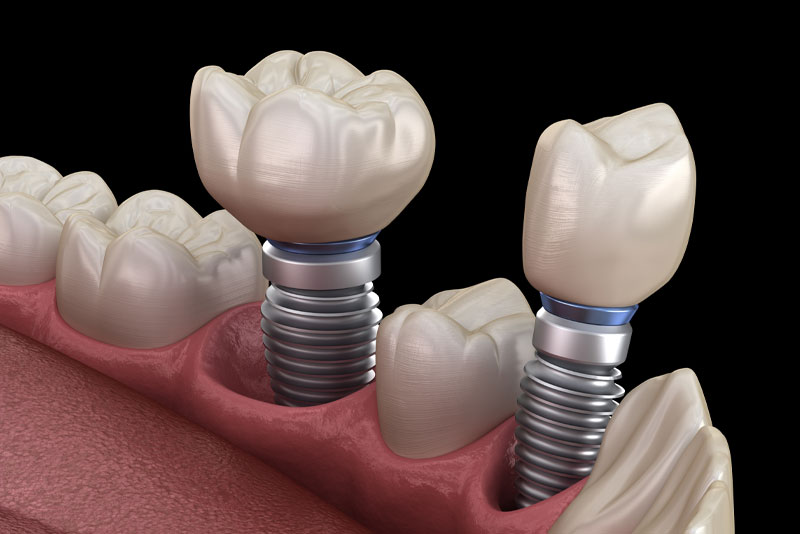 a digital model of a lower jaw showing two dental implant posts.